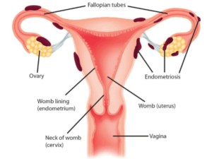 My Struggle with Endometriosis