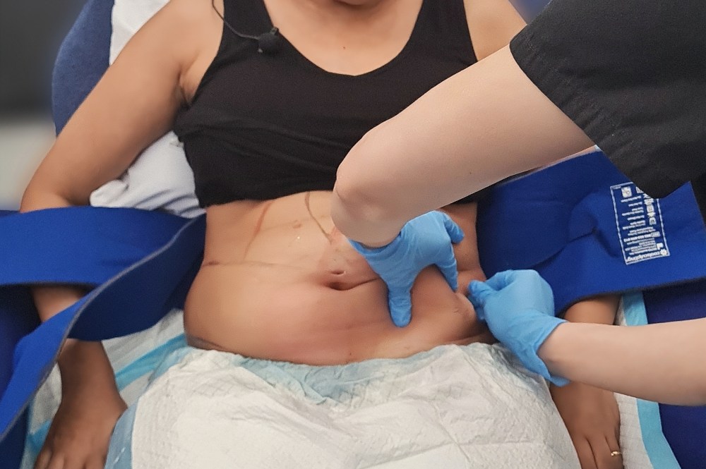 CoolSculpting Elite Fat Reduction at Halley Body Slimming